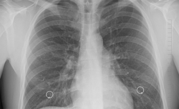 Středočeští plicní lékaři odhalili v kraji 16 nemocných 